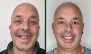 Patient with dental implants before and after